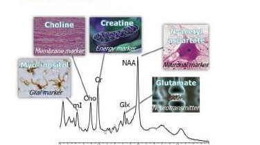 Brain ¹H MRS spectroscopy graph showing proton metabolite peaks