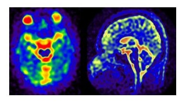 Colour-coded ²³Na sodium MRI image of a human brain, axial and sagittal views