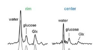 Brain ²H MRS spectra after deuterated glucose ingestion