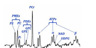 Brain ³¹P MRS spectroscopy graph showing phosphorus metabolite peaks