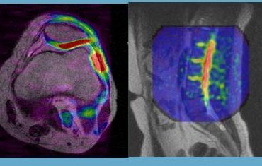 Sodium ²³Na MRI images of knee cartilage and lumbar intervertebral discs