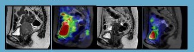 Sodium ²³Na MRI images of cervical cancer pre and post radiotherapy
