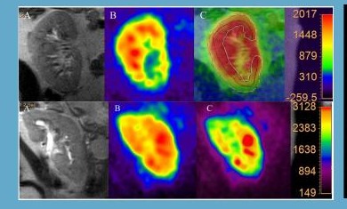 Sodium ²³Na MRI image of the kidneys, coronal view