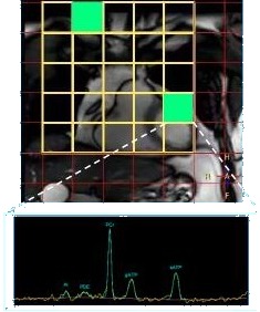 Myocardial ³¹P MRS spectrum with annotated metabolite peaks