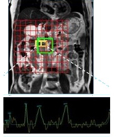 Pancreatic ³¹P MRS spectrum with annotated metabolite peaks